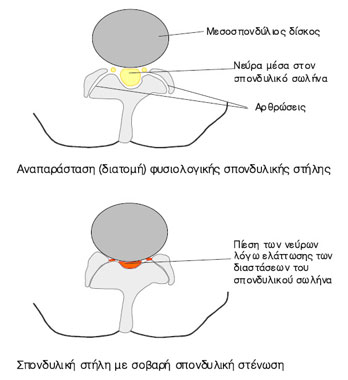 spondyliki-stenosi1