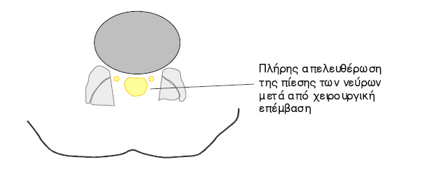 spondyliki_stenosi2