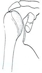 periarthritida-omou