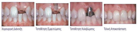 emfiteumata-dental_center