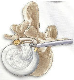 disektomi-2