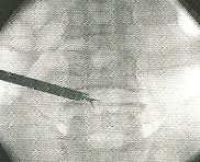 disektomi-3