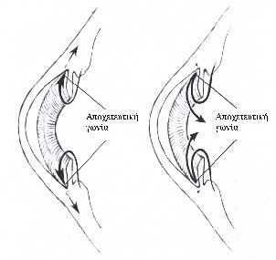 glaukoma-laservision