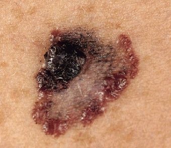 melanoma1