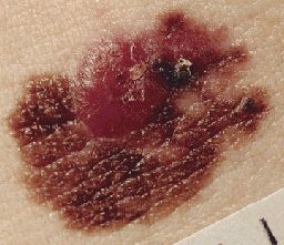 melanoma2