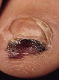 melanoma33