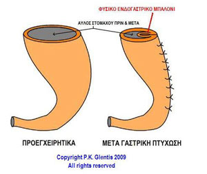 meta-gastriki-ptixwsi