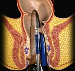 methodos-iperihon-aimorroides