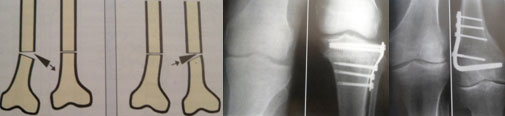 osteotomies-1