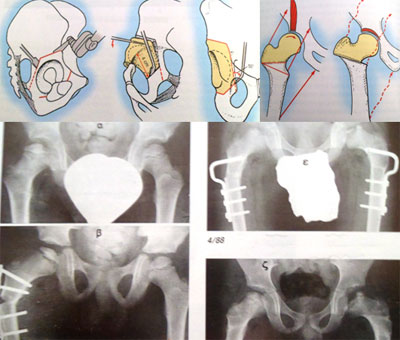 osteotomies-2