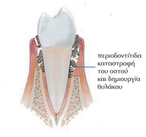 periodontitida-telikijpg