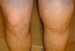 r.arthritida-3
