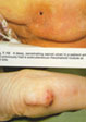 r.arthritida-8