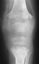 rahitida-1
