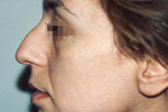 rinoplastiki-1-prin
