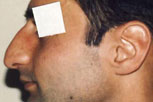 rinoplastiki-3-prin