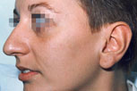 rinoplastiki-5-prin