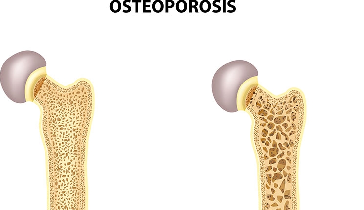 Οστεοπόρωση: Το χρόνιο νόσημα που όμως θεραπεύεται